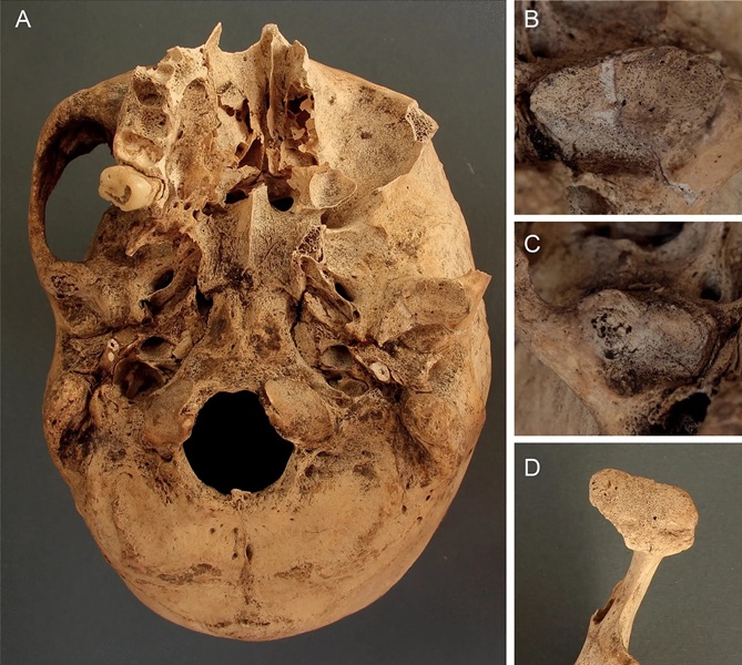جمجمه یکی از کاتبان در این مطالعه، شواهدی از آرتروز (A) و همچنین آسیب به بخشهایی از استخوان فک (B-D) را نشان داد.